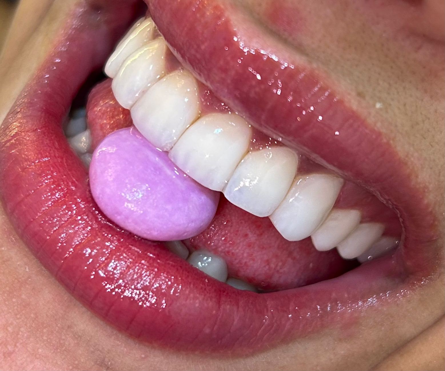 Sorriso com facetas em resina e bala de goma, publicado pela clínica